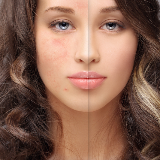 Cosmética natural para pieles sensibles o problemáticas